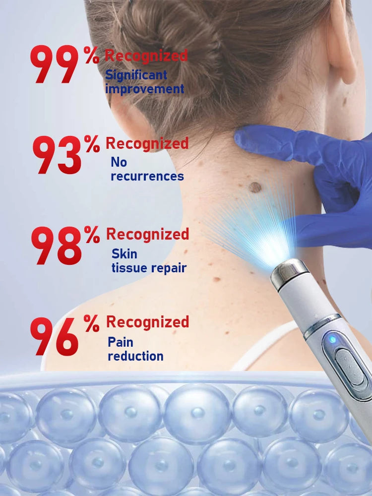 Advanced Laser Wart Remover Pen Quick Painless Home Wart Removal
