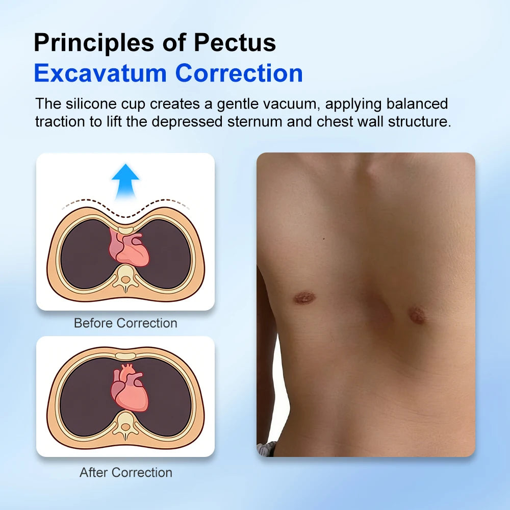 Pectus Excavatum Vacuum Bell Automatic Pump Sunken Chest Orthosis Brace