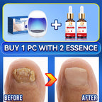 2025 Hot selling Generation-2，Rejuvenator - Fungus Prevention Technology - Adjustable Control & Safety Sensor,unisex