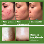 AILKE Tea Tree Oil Serum for Face and Body, Brightening, Moisturizing, Anti Acne Essence, With Vitamin E & Vitamin B3, 100ml